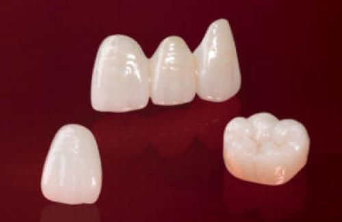 Металлические Коронки морально и физически устарели. Виды коронок 04 Металлические Коронки морально и физически устарели. Виды коронок 04