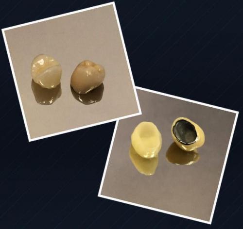 Металлокерамическая коронка виден металл. Безметалловые Коронки